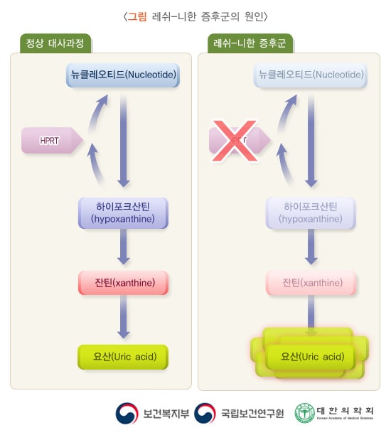 레쉬-니한증후군의 원인