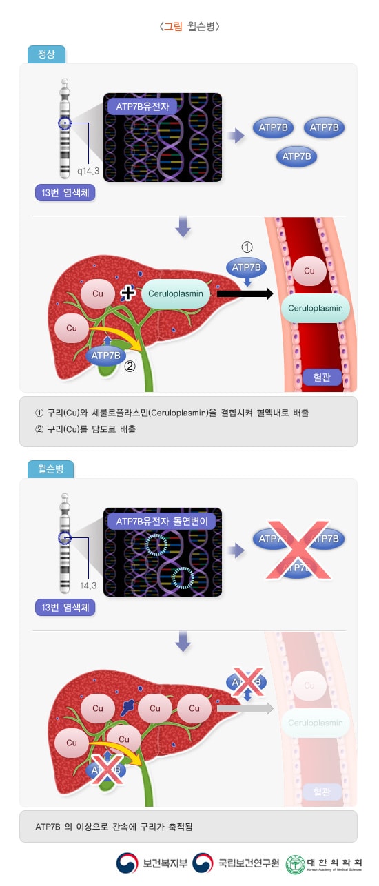 윌슨병
