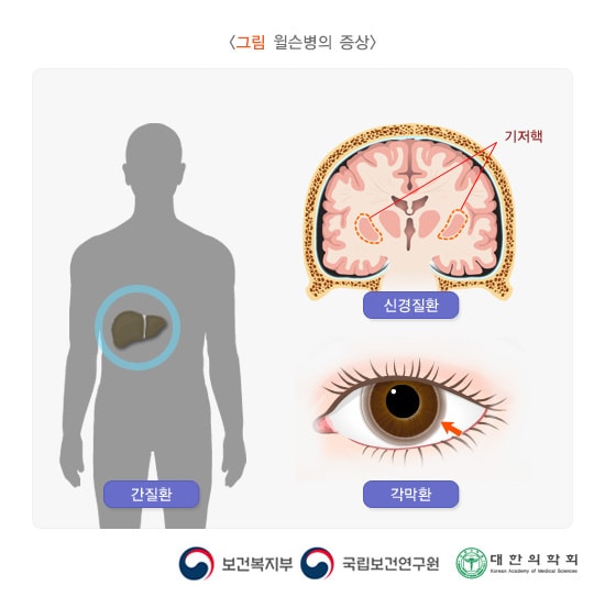 윌슨병의 증상
