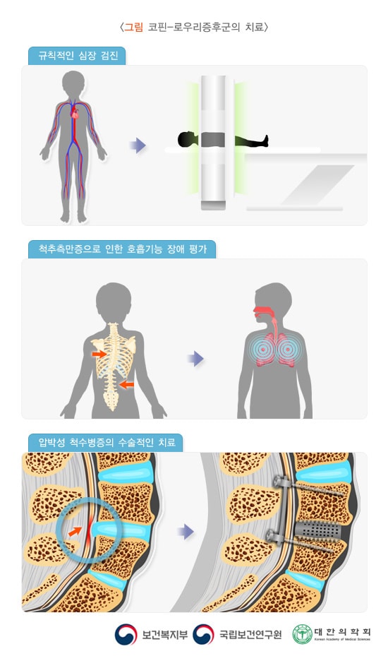 코핀-로우리증후군의 치료: 규칙적인 심장 검진, 척추측만증으로 인한 호흡기능 장애 평가, 압박성 척수병증의 수술적인 치료