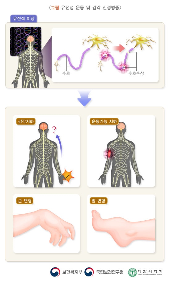 유전성 운동 및 감각 신경병증