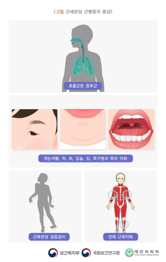그림 근세관성 근병증의 증상. 호흡곤란 증후군. 위눈커풀, 턱, 혀, 입술, 입, 목구멍과 목의 약화. 근육변성 걸음걸이, 전체 근육약화. 보건복지부, 국립보건연구원, 대한의학회
