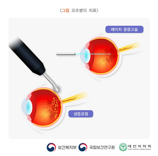 코츠병의 치료 방법 그림. 레이저 광응고술, 냉동요법. 보건복지부, 국립보건연구원, 대한의학회