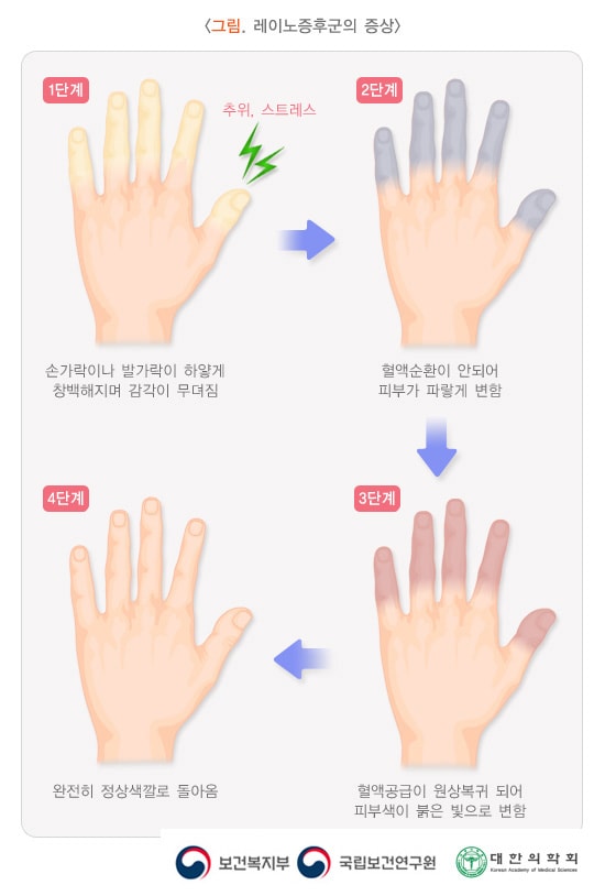 레이노증후군의 증상