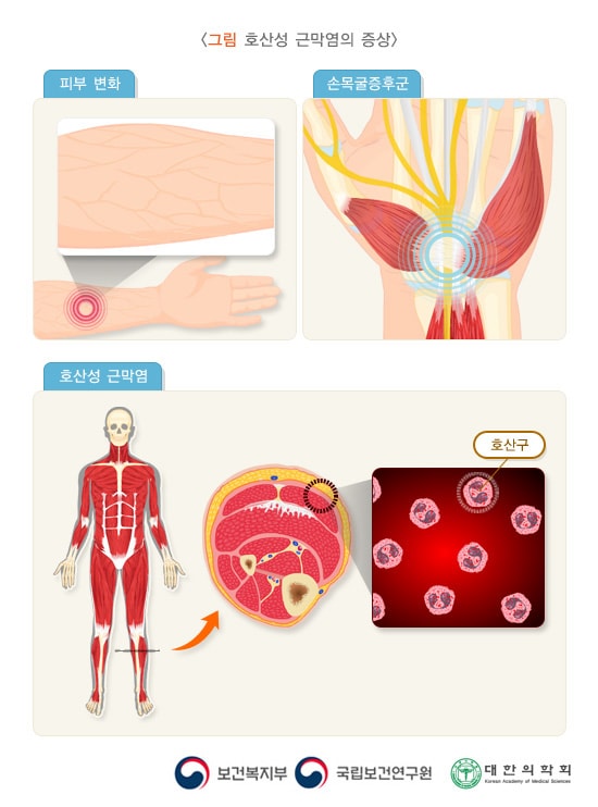 호산성 근막염의 증상