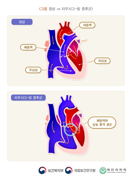 정상vs타우시그 빙 증후군