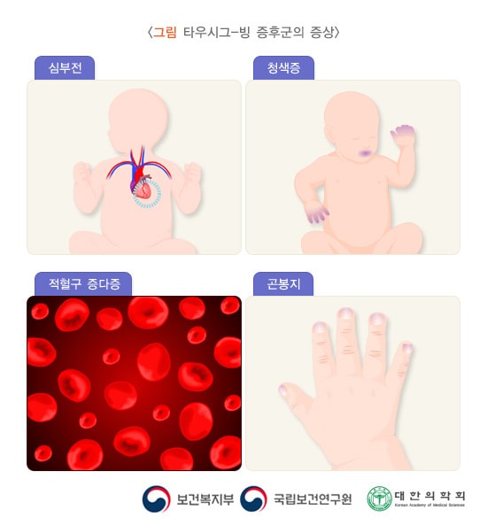 타우시그 빙 증후군의 증상