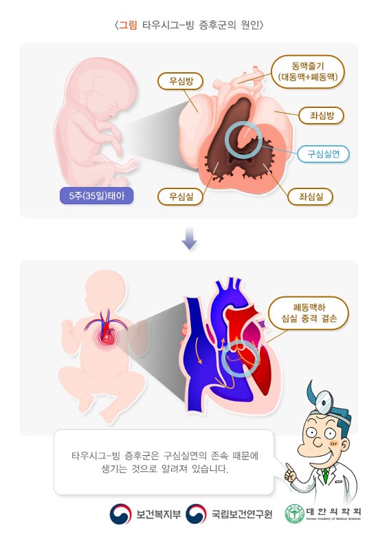 타우시그 빙 증후군의 원인
