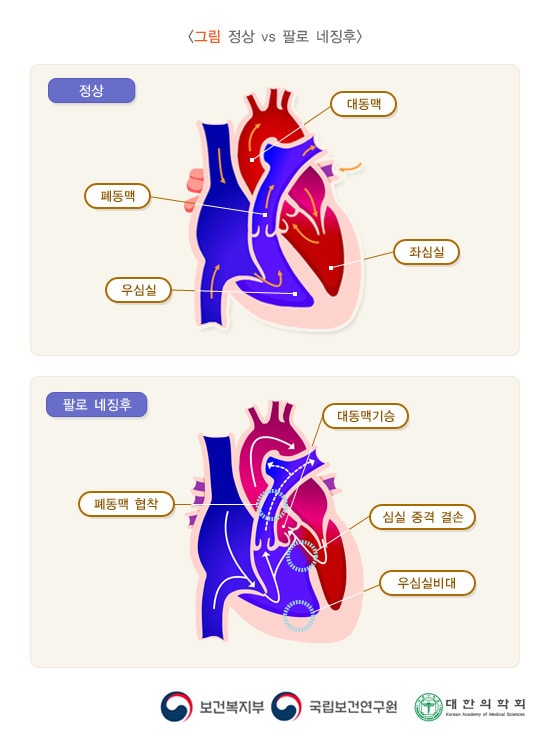 정상 vs 팔로 네증후