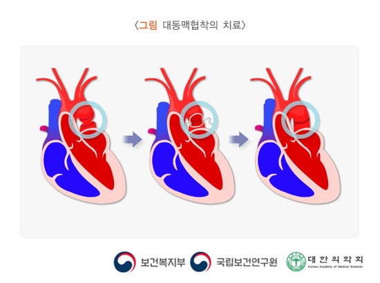 대동맥협착의 치료