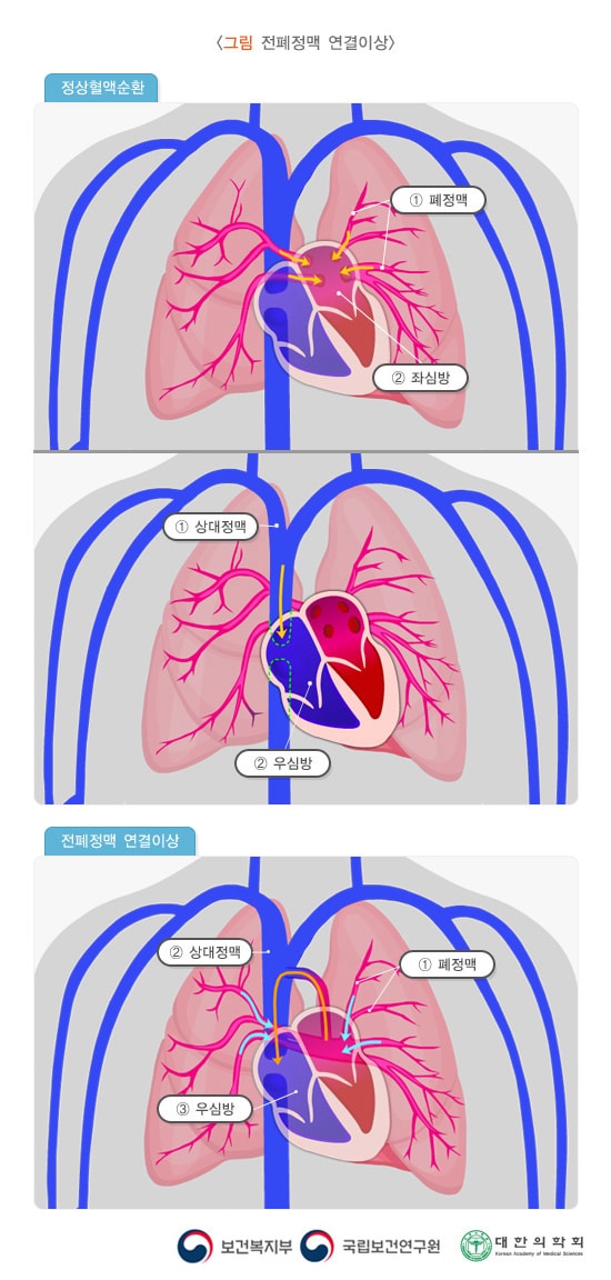 전폐정맥 연결이상