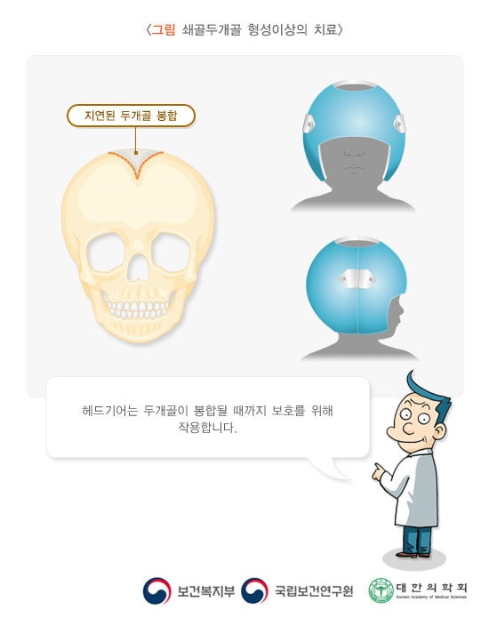 쇄골두개골 형성이상의 치료
