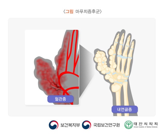마푸치증후군