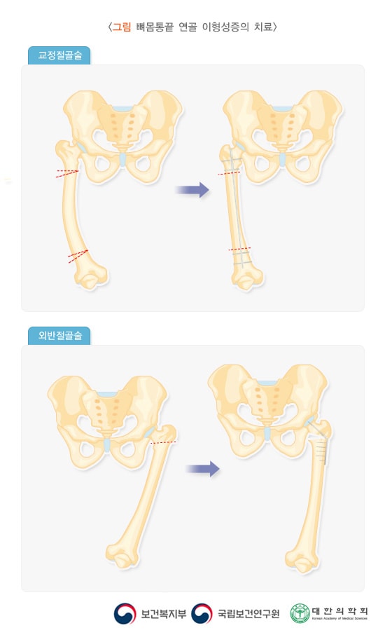 뼈몸통끝 연골 이형성증의 치료