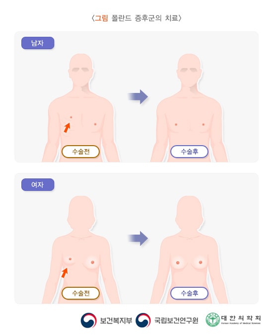 폴란드증후군의 치료