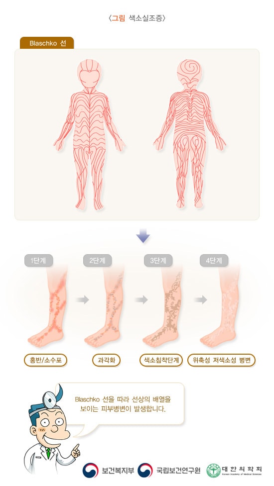 색소실조증