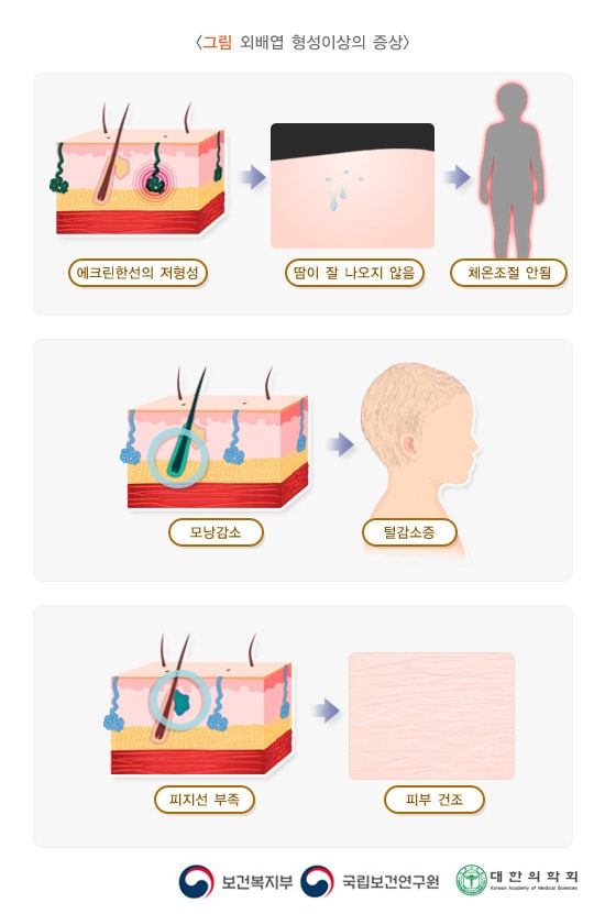 외배엽 형성이상의 증상/에크린한선의 저형성/ 땀이 잘나오지 않음/ 체온조절 안됨/모낭감소/털감소증/피지선부족/피부건조