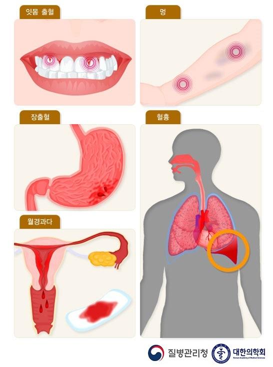 제1인자 결필증의 증상