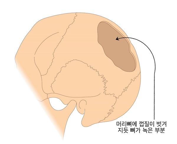 머리뼈에 껍질이 벗겨 지듯 뼈가 녹는 부분 그림