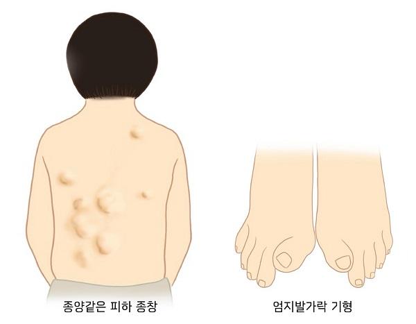 진행성 골화섬유형성이상 증상 그림-종양같은 피하 종창,엄지발가락 기형