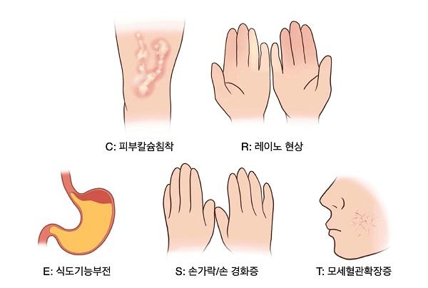 C:피부칼슘침착,R:레이노 현상,E:식도기능부전,S:손가락/손 경화증,T:모세혈관확장증 그림
