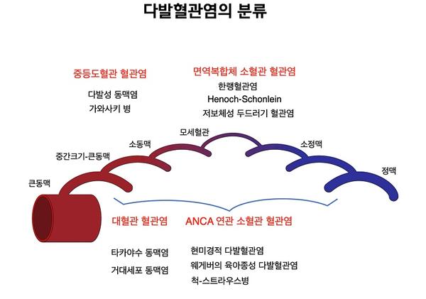 다발형관염의 분류 그림-중등도혈관 혈관염(다발성 동맥염,가와사키병),면역복합체 소혈관 혈관염(한랭혈관염,Henoch0Schonlein,저보체성 두드러기 혈관염),대혈관 혈관염(타카야수 동맥염,거대세포 동맥염),ANCA 연관 소혈관 혈관염(현미경적 다발혈관염,웨게버의 육아종성 다발혈관염,척-스트라우스병)