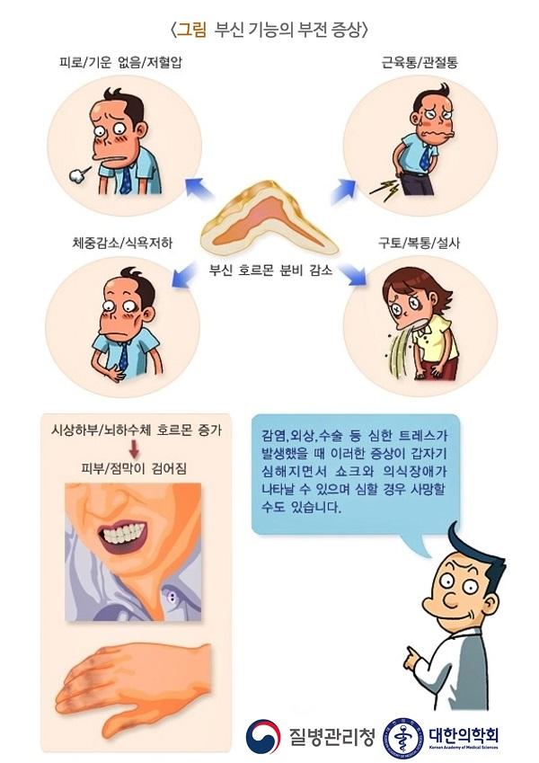 부신 기능의 부전 증상 그림. 부신 호르몬 분비 감소. 피로/기운 없음/저혈압/체중감소/식욕저하/근육통/관절통/구토/복통/설사. 시상하부/뇌하수체 호르몬 증가. 피부/점막이 검어짐. 감염, 외상, 수술 등 심한 스트레스가 발생했을 때 이러한 증상이 갑자기 심해지면서 쇼크와 의식장애가 나타날 수 있으며 심할 경우 사망할 수도 있습니다. 질병관리청, 대한의학회