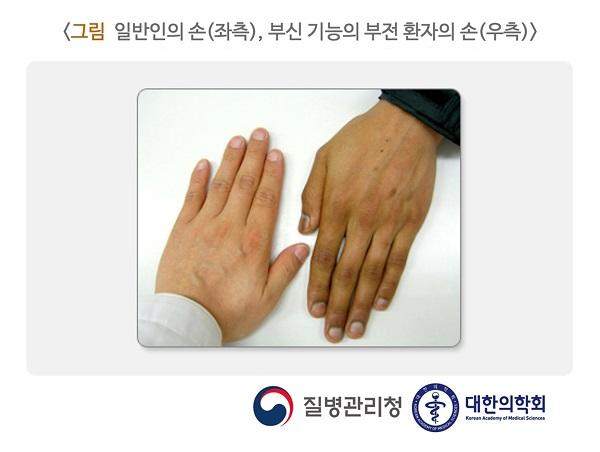 일반인의 손(좌측), 부신 기능의 부전 환자의 손(우측)