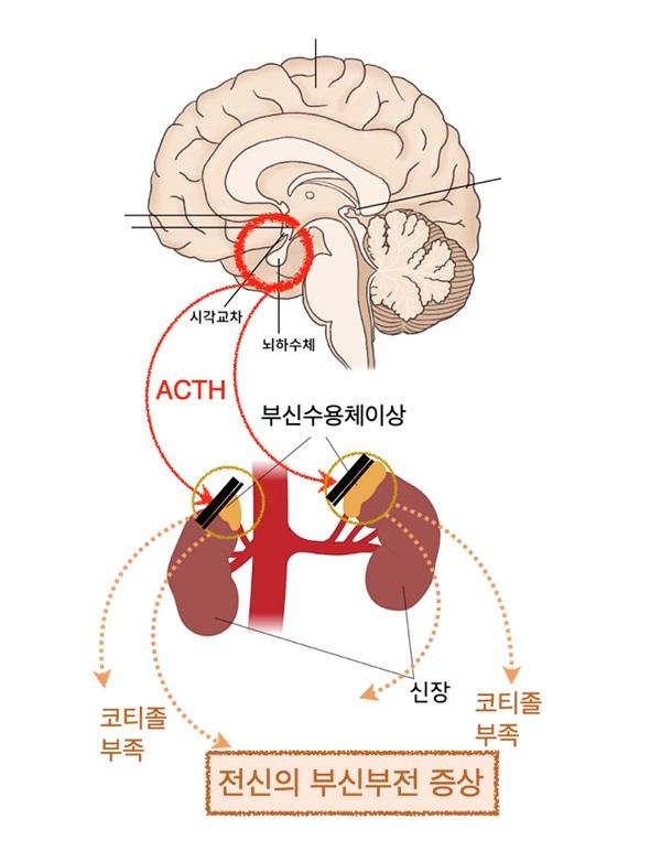전신의 부신부전 증상 그림. 시각교차, 뇌하수체. ACTH. 부신수용체이상. 코티졸 부족. 전신의 부신부전 증상