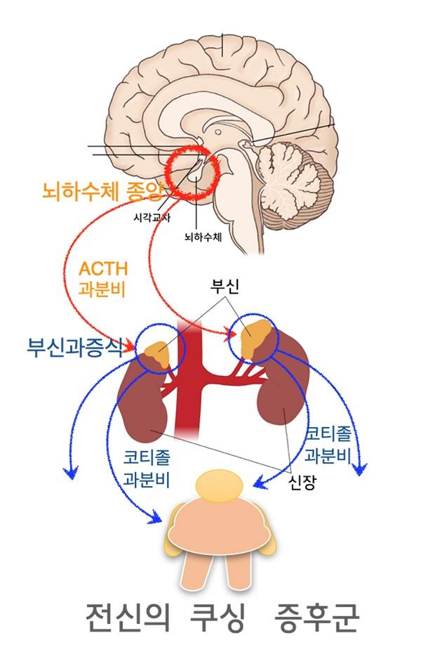 뇌하수체-의존 쿠싱병 원인 그림