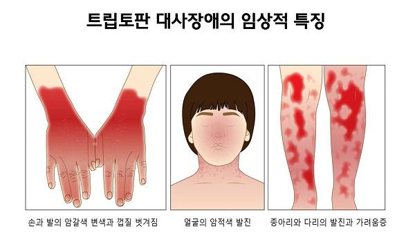 트립토판 대사장애의 임상적 특징 그림. 손과 발의 암갈색 변색과 껍질 벗겨짐. 얼굴의 암적색 발진. 종아리와 다리의 발진과 가려움증
