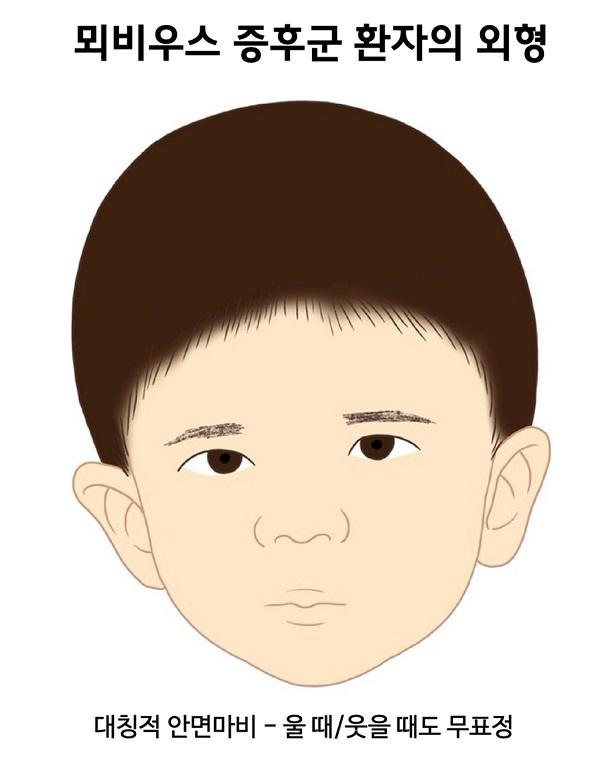 뫼비우스 증후군 환자의 외형 그림