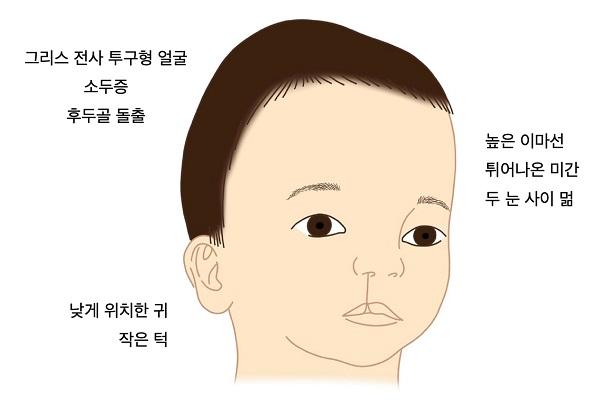 월프-허쉬호른증후군 증상 그림-그리스 전사 투구형 얼굴,소두증,후두골 돌출,낮게 위치한 귀,작은턱,높은 이마선,튀어나온 미간,두 눈 사이 멂