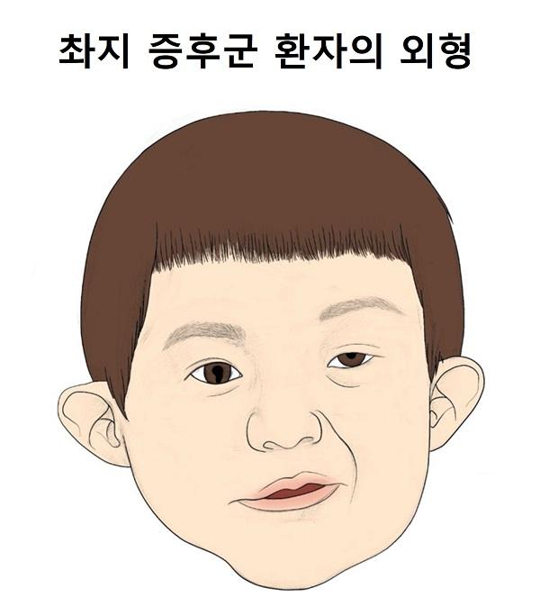 최지 증후군 환자의 외형 그림