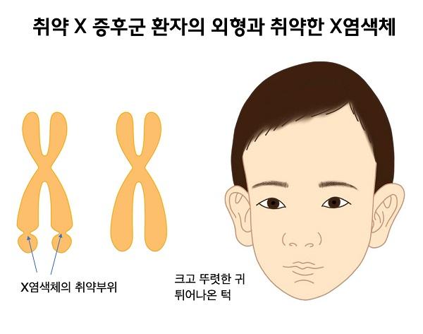 취약X증후군 환자의 외형과 취약한 X염색체