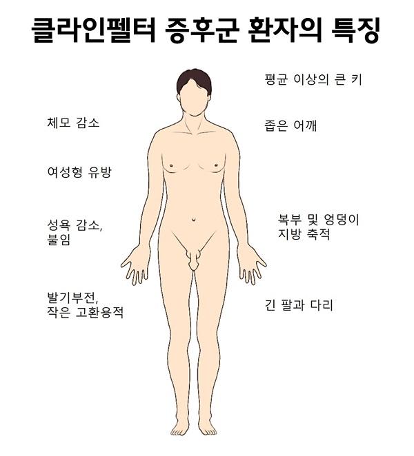 클라인펠터 증후군 환자의 특징 그림-체모 감소,여성형 유방,성욕 감소,불임, 발기부전,작은 고환용적,평균 이상의 큰 키,좁은 어깨,복부 및 엉덩이 지방 축적,긴 팔과 다리
