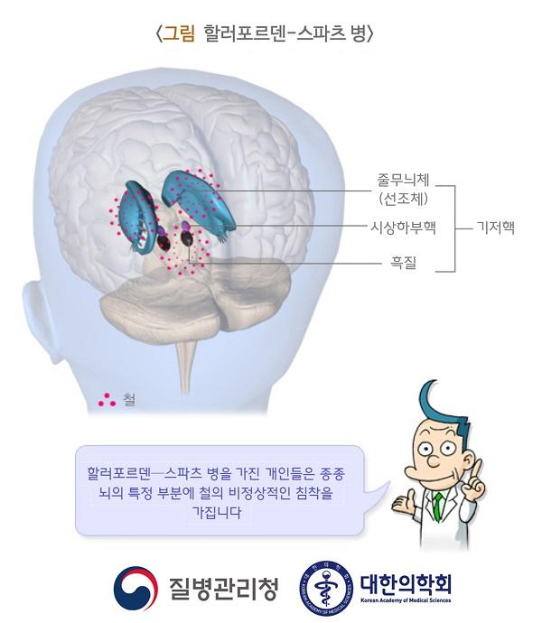 할러포르덴-스파츠 병 그림. 기저핵부분인 줄무늬체(선조체), 시상하부핵, 흑질에 철. 할러포르덴-스파츠 병을 가진 개인들은 종종 뇌의 특정 부분에 철의 비정상적인 침착을 가집니다. 질병관리청, 대한의학회