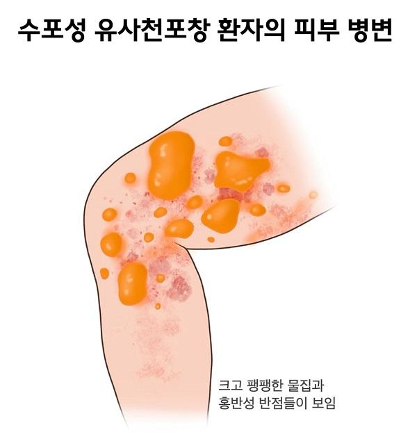 수포성 유사천포창 환자의 피부 병변 그림. 크고 팽팽한 물집과 홍반성 반점들이 보임.