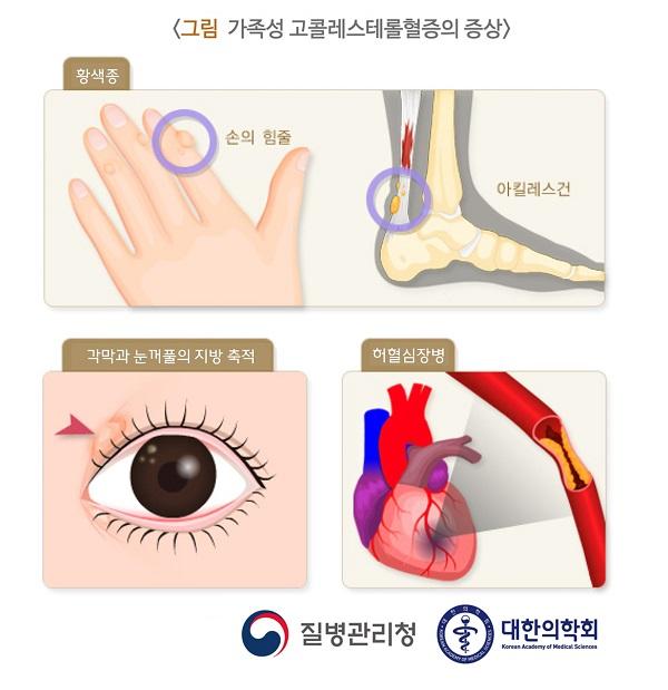 가족성 고콜레스테롤혈증의 증상 그림-황색종:손의 힘즐,아킬레스건,각막과 눈꺼풀의 지방 축척,허혈심장병