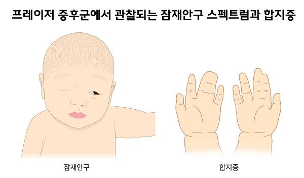 프레이저 증후군에서 관찰되는 잠재안구 스펙트럼과 합지증 그림-잠재안구,합지증