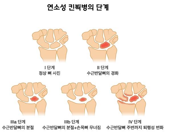 연소성 킨뵉병의 단계 그림-1단계 정상뼈사진 2단계 수근반달뼈의 경화 3a단계 수근반달뼈의 분절 3b단계 수근반달뼈의 분절+손목뼈 무너짐 4단계 수근반달뼈 주변까지 퇴행성 변화