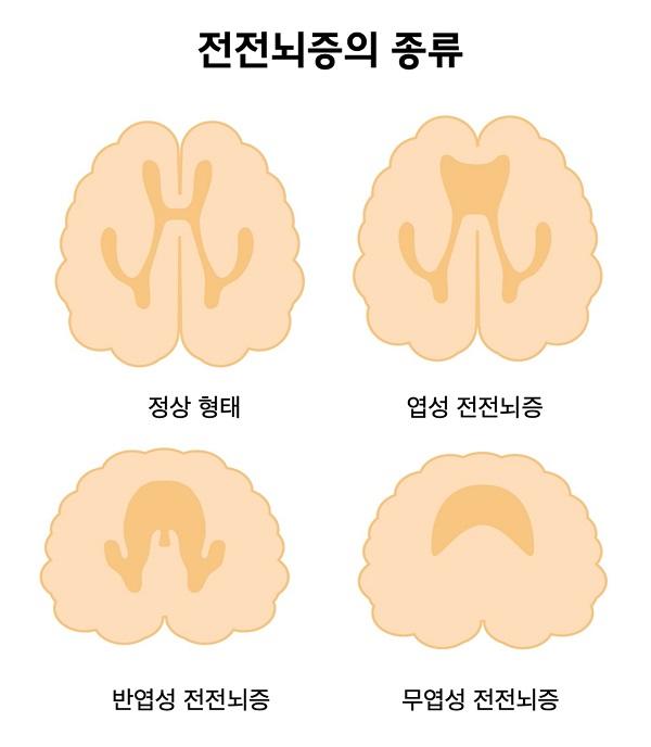 전전뇌증의 종류 그림-정상형태, 엽성 전전뇌증, 반엽성 전전뇌증, 무엽성 전전뇌증