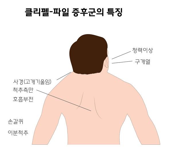 클리펠-파일 증후군의 특징-청력이상,구개열,사경(고개기울임),척추측만,호흡부전,손갈퀴,이분척추