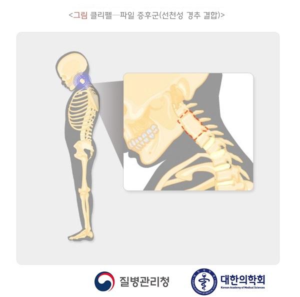 클리펠-파일 증후군(선천성 경추 결합) 그림