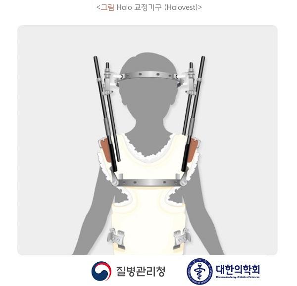 Halo 교정기구(Halovest) 그림