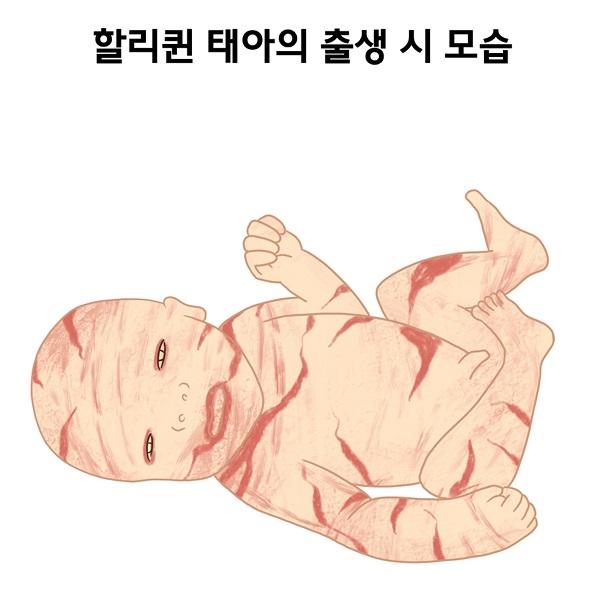 할리퀸 태아의 출생 시 모습 그림