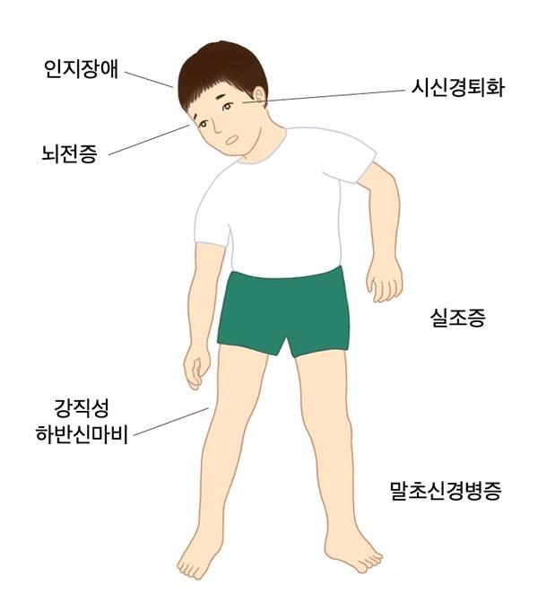 KIF1A 유전자 돌연변이에 의한 신경병증 증상 그림-인지장애,시신경퇴화,뇌전증,강직성 하반신마지,실조증,말초신경병증
