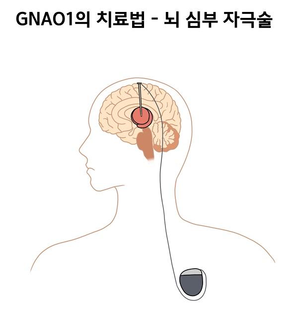 GNAO1의 치료법-뇌 심부 자극술 그림