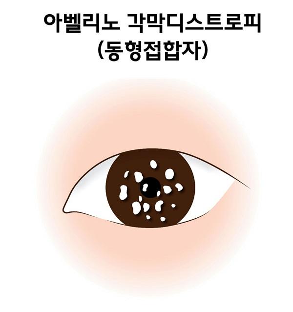아벨리노 각막디스트로피(동형접합자) 그림