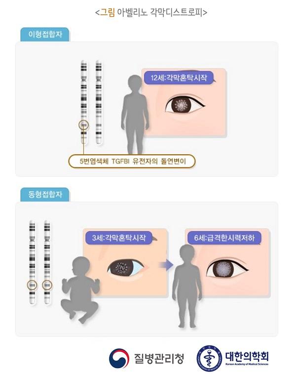 아벨리노 각막디스트로피 그림-이형접합자 5번염색체 TGFBI 유전자의 돌연변이 12세:각막혼탁시작, 동형접합자 3세:각막혼탁시작 6세:급격한시력저하